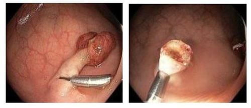 Treating colon polyps through endoscopic surgery.