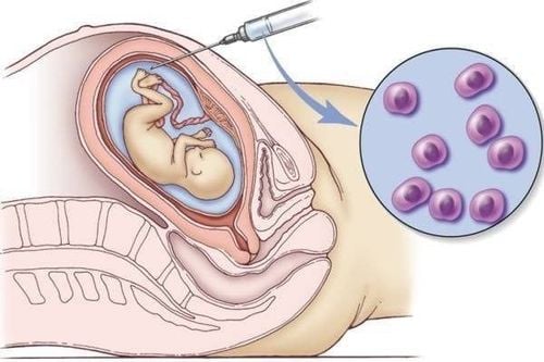 Chorionic villus sampling for diagnosis of single umbilical artery