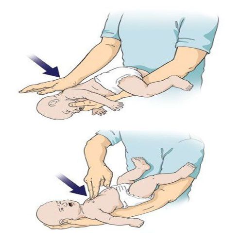 Cách sơ cứu trẻ bị sặc đờm