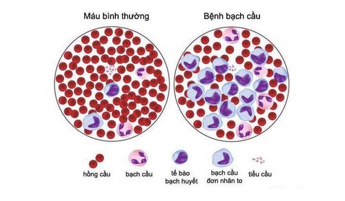 Tế bào máu khi mắc bệnh bạch cầu mãn tính dòng lympho