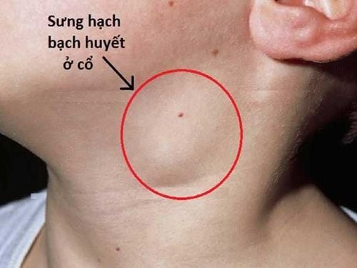 Lymph nodes can be found in many areas of a child's body, such as the neck or groin.