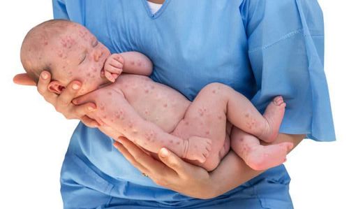 Trẻ mắc Rubella bẩm sinh