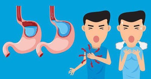Thường xuyên ợ nóng và bị trào ngược axit dạ dày - thực quản có nguy cơ cao mắc Barret thực quản