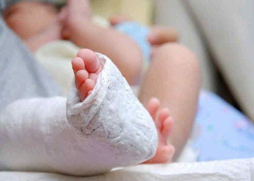 
Bó bột chỉnh hình là phương pháp được chỉ định cho trẻ dưới 6 tháng tuổi
