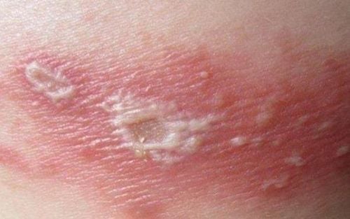 Shingles can spread before the blisters crust over
