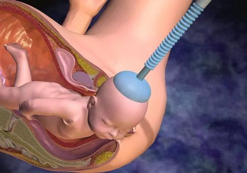 The use of vacuum extraction during delivery is also a contributing factor to cervical trauma.