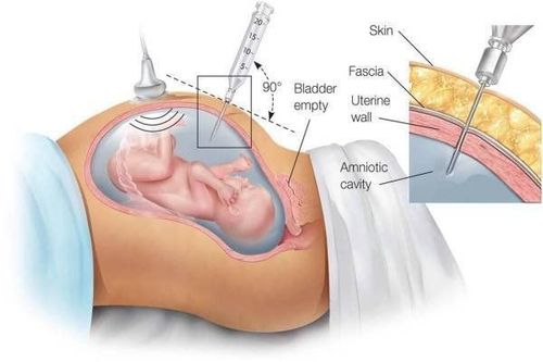 Dịch ối là loại mẫu sử dụng trong xét nghiệm QF - PCR