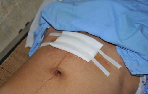 Sau phẫu thuật cần theo dõi tình trạng chảy máu vết mổ