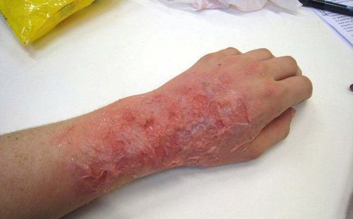 Phương pháp bán hở thường dùng đối với những vết bỏng khô