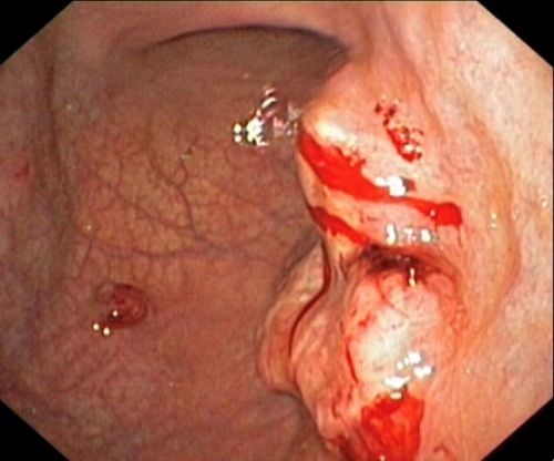 Image of gastric cancer endoscopy