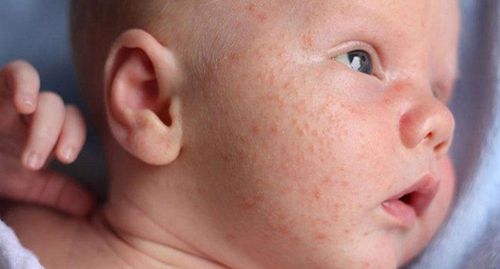 Trẻ sốt virus vẫn nên tắm để đề phòng bị mắc các bệnh da liễu