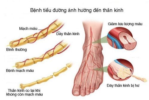 Viêm dây thần kinh ngoại biên do biến chứng của bệnh lý đái tháo đường là thường gặp