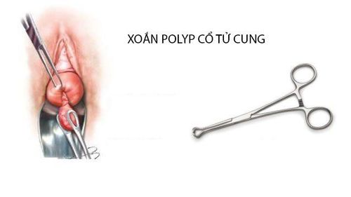 Nhiều chị em lo lắng cắt polyp tử cung có đau không, dù phẫu thuật này là cần thiết, nhằm giảm thiểu những khó chịu và ảnh hưởng đến sinh hoạt do polyp gây ra. 