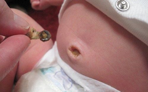 A newborn's umbilical stump with white or yellow pus is a sign of infection caused by pus-forming bacteria. 
