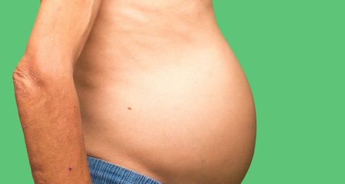 Hình ảnh bệnh nhân bị cổ trướng