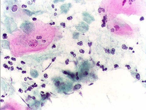Hình ảnh phóng đại nhuộm màu virus Trichomoniasis