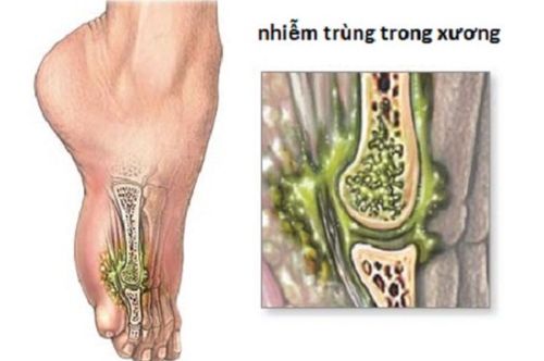 Viêm xương- tủy xương