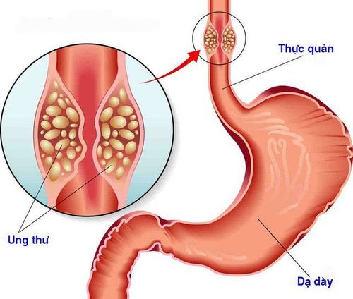 Ung thư thực quản là biến chứng nguy hiểm nếu người bệnh không được chẩn đoán và điều trị kịp thời