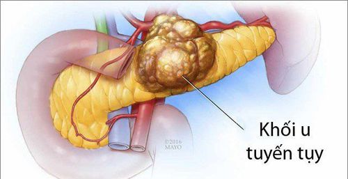 Ung thư tuyến tụy khiến người bệnh mệt mỏi, buồn nôn