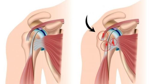 Rách chóp xoay là một trong những nguyên nhân phổ biến gây đau và giảm vận động của khớp vai