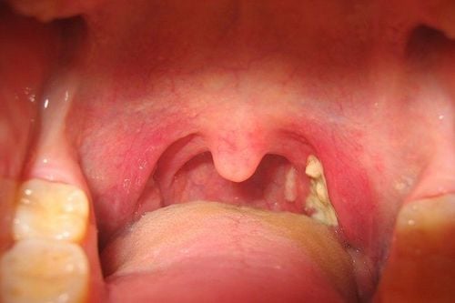 Image of a Patient with Streptococcal pharyngitis