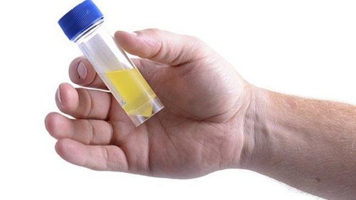 Nước tiểu giữa dòng được sử dụng làm xét nghiệm