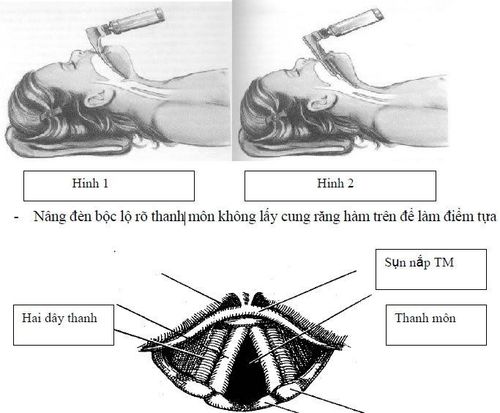 
Kỹ thuật đặt nội khí quản
