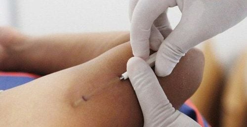 Phương pháp cấy que tránh thai gây vô kinh khá phổ biến