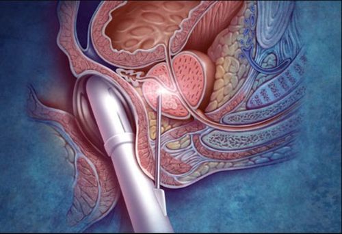 Siêu âm xâm lấn - siêu âm đầu dò trực tràng