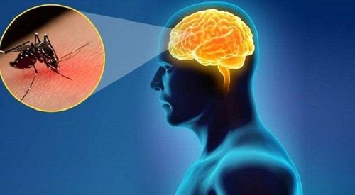 
Hình ảnh đặc trưng của bệnh viêm não nhật bản là tổn thương đồi thị ở hai bên và thân não
