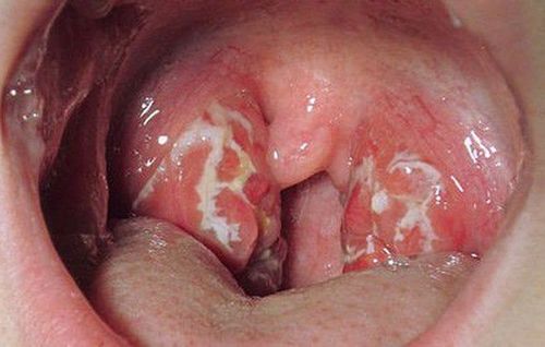 Hình ảnh màng trắng xuất hiện tại bề mặt amidan của bệnh nhân