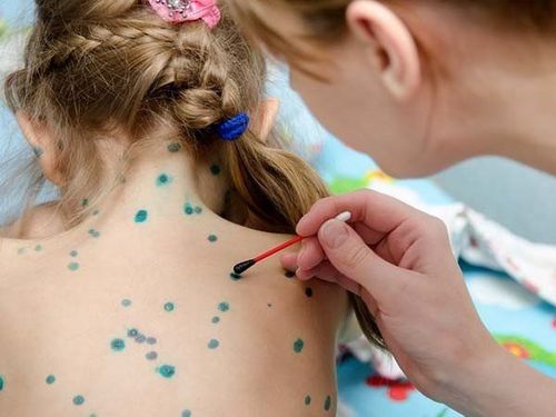 Long-term steroid use after chickenpox increases the risk of shingles