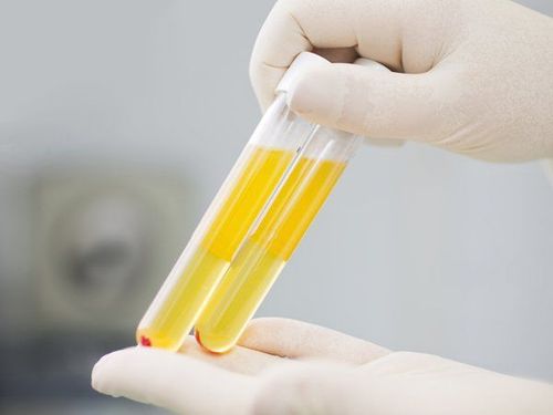 
Tại Trung Quốc,sàng lọc huyết thanh vì tiêu chảy mãn tính để chẩn đoán về mặt mô học với bệnh Celiac
