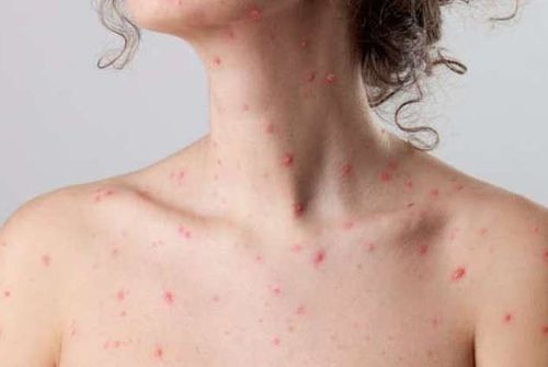 Bị thủy đậu trước khi mang thai liệu có ảnh hưởng đến thai nhi?