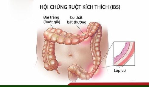 
Hình ảnh mô phỏng hội chứng ruột kích thích
