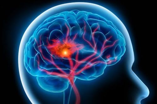 Đột quỵ tai biến mạch máu não là bệnh có thể gây tử vong nhanh, có tỷ lệ tử vong cao, đứng hàng đầu trong các bệnh lý ở hệ thần kinh