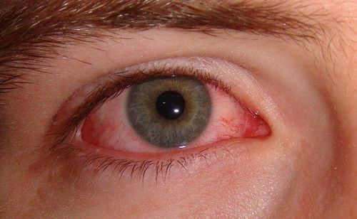 Lupus can cause painful inflammation of the dura mater.