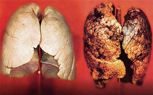 Nội soi phế quản có thể chẩn đoán được ung thư phổi