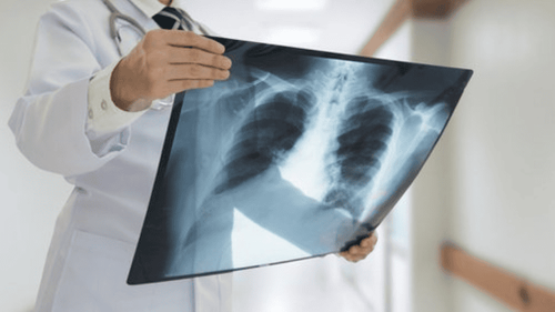 X quang phổi là xét nghiệm cận lâm sàng quan trọng nhất trong chẩn đoán bệnh lý phổi