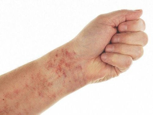 Causes of increased liver enzymes in people with dengue fever