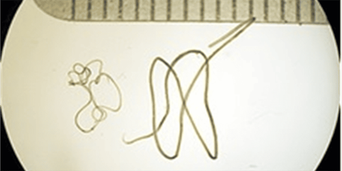 The Value of Ultrasound in Diagnosing Parasitic Worms  