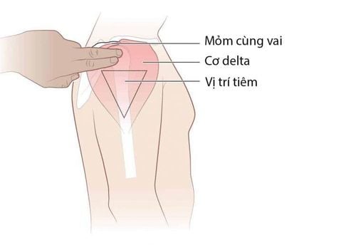 Vị trí tiêm bắp thông dụng đang được ứng dụng trên lâm sàng hiện nay