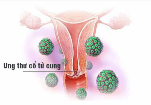 Chỉ định dẫn lưu bể thận qua da do nguyên nhân ung thư cổ tử cung