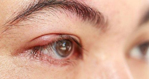 Lupus can also spread and cause a thick rash on the eyelids