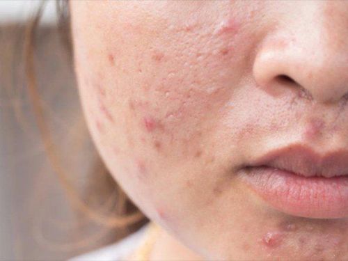 Nổi mụn nhiều là một trong các tác dụng phụ của que cấy tránh thai