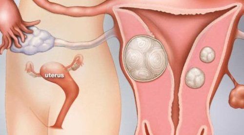
U xơ tử cung là nguyên nhân gây vô sinh ở phụ nữ
