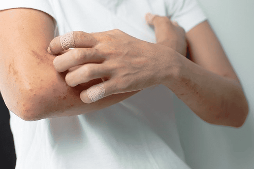 Dị ứng có thể xảy ra khi người bệnh tiểu đường dùng nhóm thuốc ức chế men DPP-4