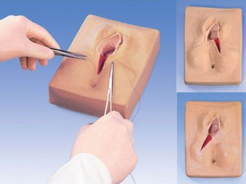 The sutures in the perineum usually begin to dissolve within a few days and disappear after one or two weeks