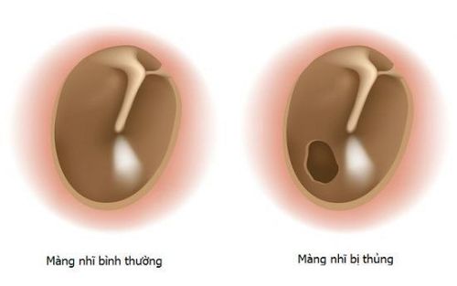 Thủng màng nhĩ là tình trạng xuất hiện một lỗ thủng hoặc vết rách trên màng nhĩ