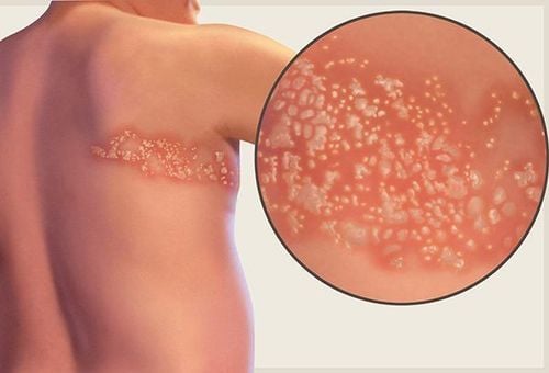 Tiêm ngừa vắc -xin giúp phòng ngừa và tái hoạt động của virus gây bệnh zona